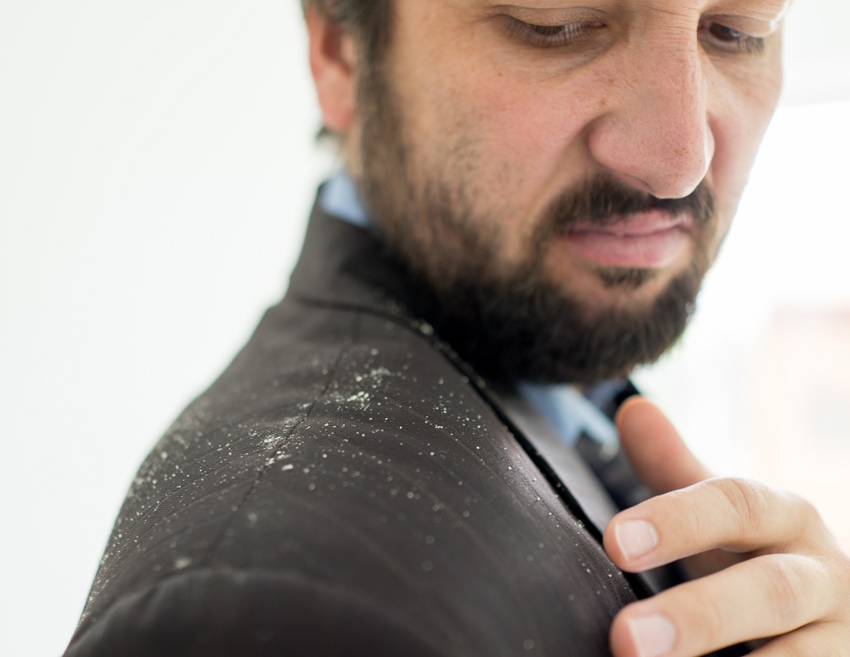 Dandruff on shoulder of man