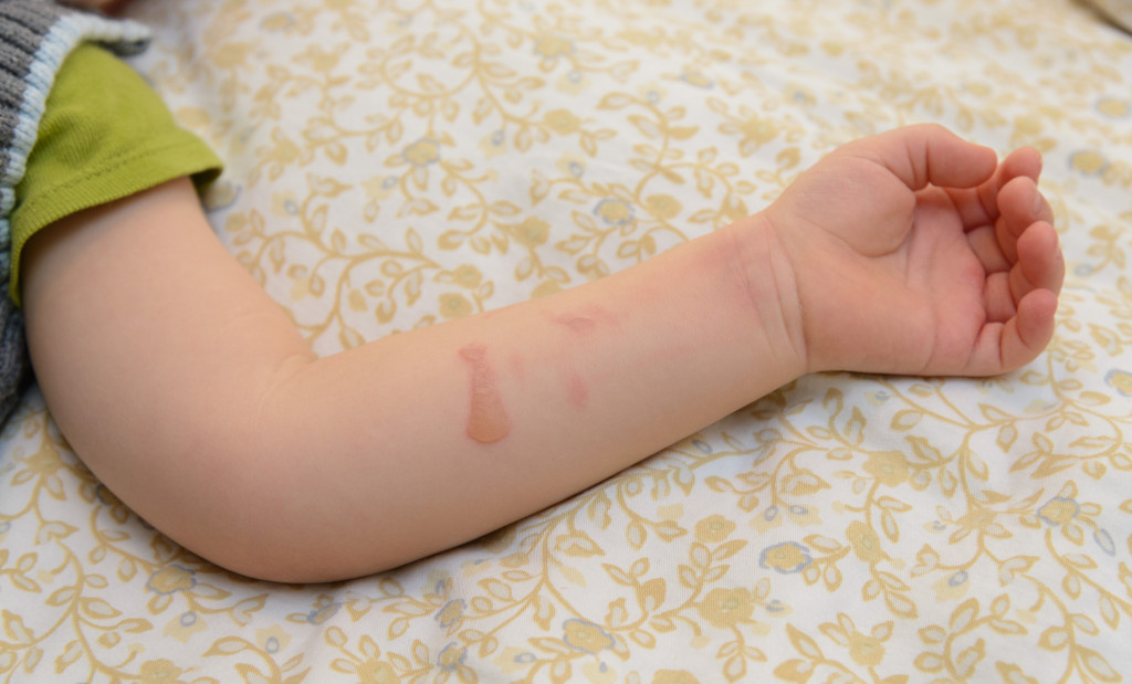 skin issue on a child's arm