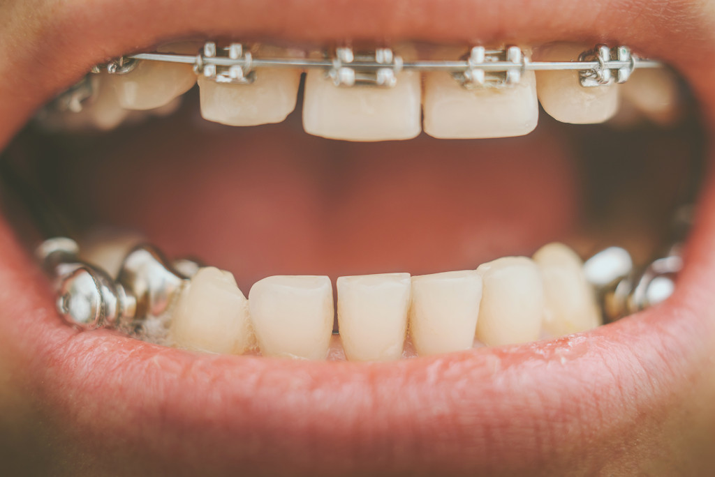 Metal braces on someone's teeth